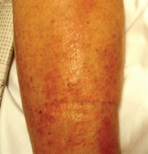 Edema In Legs And Lower Leg at Monika Demers blog