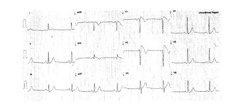 Brugada syndrome — Knowledge Hub