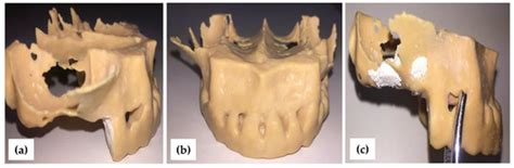 JCM | Special Issue : 3D Printing and Virtual Surgical Planning in Oral ...