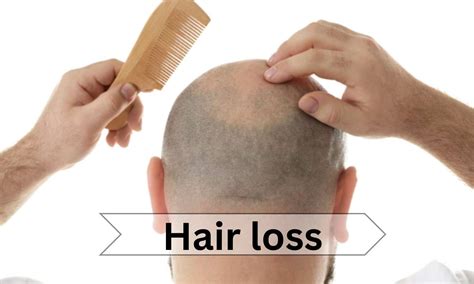 Long-term therapy Baricitinib improves hair growth in severe alopecia ...