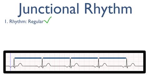 Junctional Rhythm – Nursing Unraveled