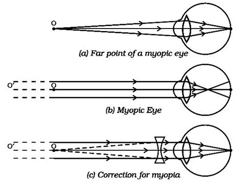 draw a ray diagram of myopic eye and its rectification. - Brainly.in