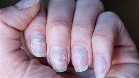 https://www.thelist.com/img/gallery/if-youre-nails-are-peeling-heres-how-you-should-treat-them/l-intro-1640605426.jpg?utm_source=chatgpt.com