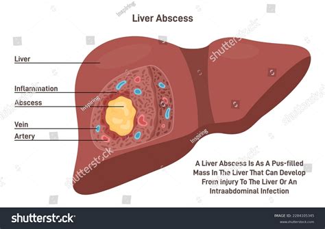 Liver Abscess Human Internal Organ Tissue Stock Vector (Royalty Free ...