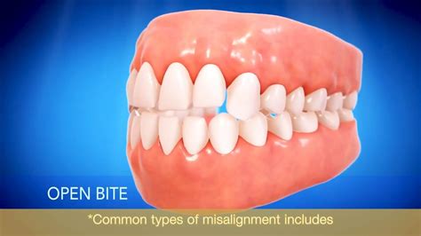 Invisalign Animation 的图像结果