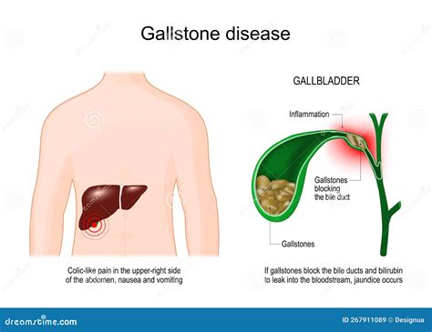 Gallstone Disease. Cross Section of Gallbladder with Gallstones Stock Vector - Illustration of ...