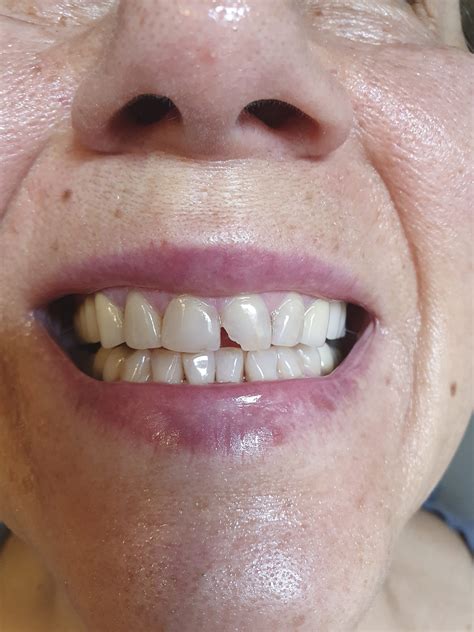 Image result for Broken Tooth