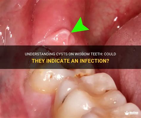 Wisdom Tooth Cyst Removal 的图像结果
