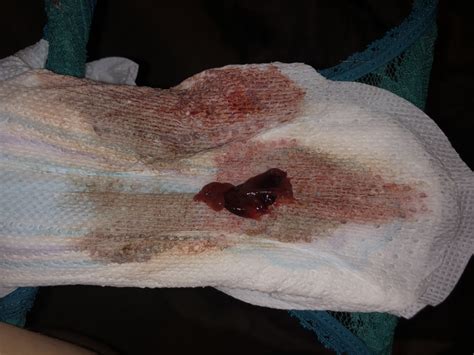 Heavy Blood Clotting During Periods