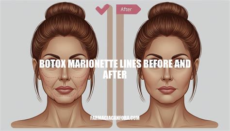 Marionette Lines Botox Injection Sites at Poppy Bleasdale blog