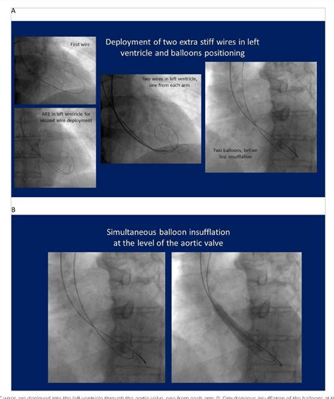 Figure 1 from Balloon Aortic Valvuloplasty in the Transcatheter Aortic Valve Implantation Era ...