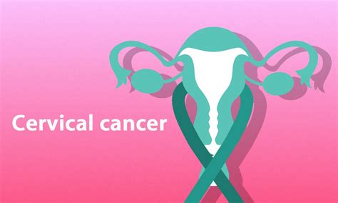 American Cancer Society updates guidelines on cervical cancer screening