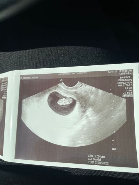 9 Weeks Pregnant Ultrasound 2022