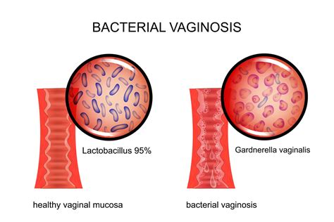 5 Ways To Use Essential Oils For Bacterial Vaginosis (Vaginal Bacteriosis) | Essential Oil Benefits