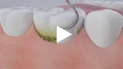 Dental Videos in San Diego & College | Beautiful Smile Dentistry