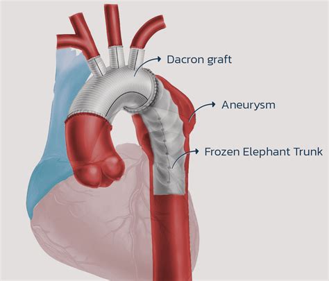 Breakthrough in Cardiac Surgery: AUBMC Performs the First Successful Frozen Elephant Trunk ...