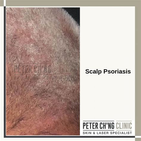 Hair Loss Scalp Psoriasis at Robert Hubbard blog
