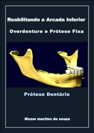 Reabilitando a Arcada Inferior Overdenture e Prótese Fixa: Prótese ...
