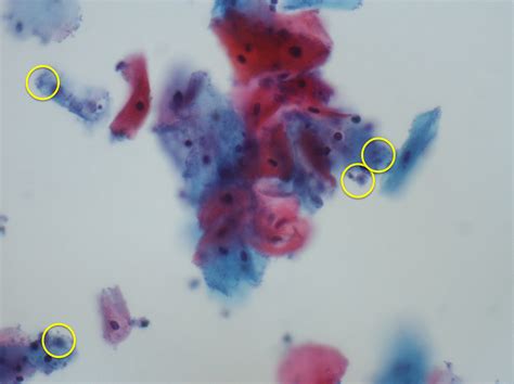 Trichomonas Vaginalis Wet Mount How To Diagnose And Manage Trichomonas