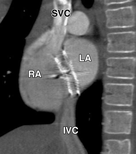MDCT Evaluation After Closure of Atrial Septal Defect with an Amplatzer Septal Occluder | AJR