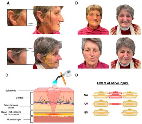 Iatrogenic Facial Nerve Palsy Following Dermatologic Cryotherapy: A ...