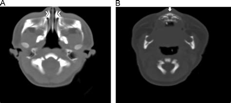 Pyriform aperture stenosis repair in infants - Operative Techniques in Otolaryngology-Head and ...
