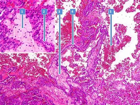 Altblutiger Urin nach sportlicher Aktivität | VIVOCASE
