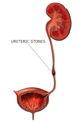 Laser treatment for Ureteric Stone - Samved Urology Hospital