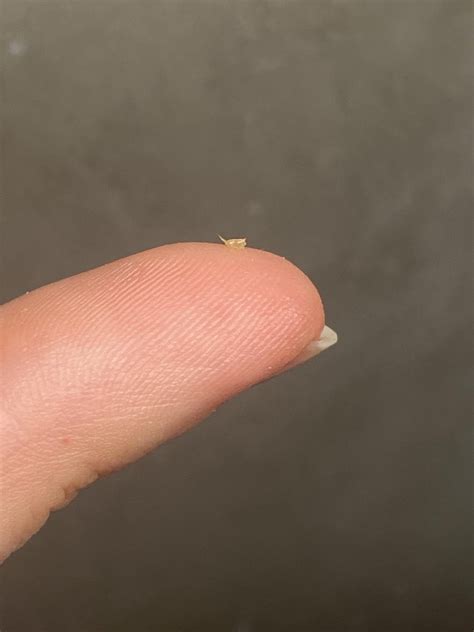 Image result for Sebum Plug Extraction