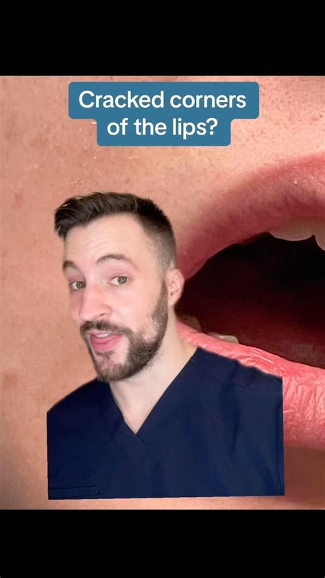Best 13 CRACKED LIP CORNERS – what causes them and how to heal fast – Artofit