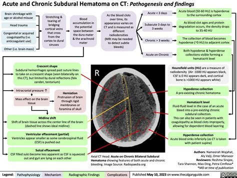 Subdural Hematoma on CT: Pathogenesis and findings | Calgary GuideCalgary Guide