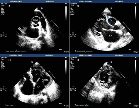 Aneurysm of the right sinus of Valsalva dissecting into the interventricular septum, submitral ...