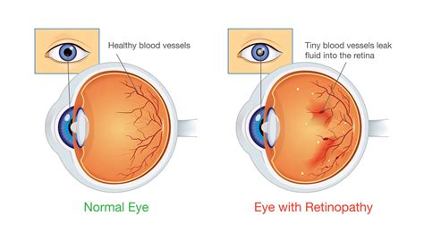 What is Diabetic Retinopathy? - The Lighthouse for the Blind, Inc.