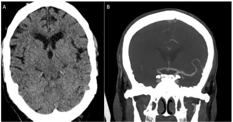 The Stream Device—A Retrospective Review of 51 Cases