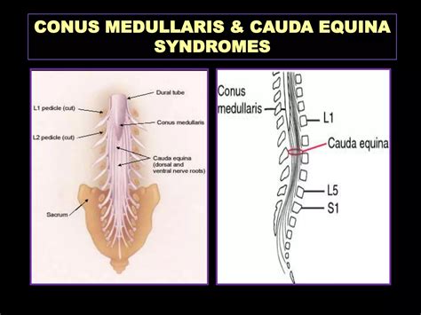 Spinal cord syndromes | PPSX