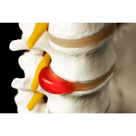 Slip Disc Treatment By Physiotherapy at Sybil Downing blog