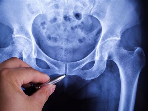 Das Bermudadreieck der Leiste - Orthopädie & Traumatologie ...