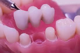 Benefits of Dental Bridges Dental Clinic Pragathi Nagar