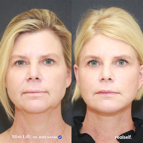 Discover the Benefits of a Mini Facelift