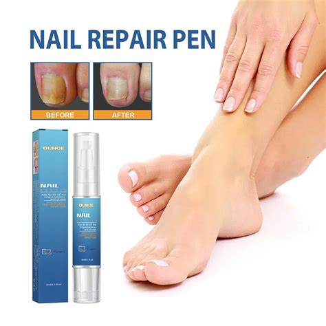 Anti Fungal Nail Solution Onychomycosis Paronychia | Ubuy India