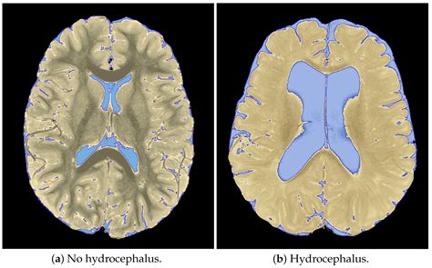 Reliability of Automated Intracranial Volume Measurements by Synthetic ...