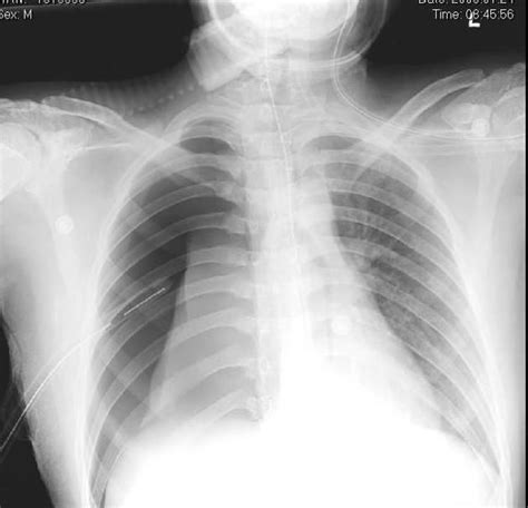 Sulcus Sign Explained 的图像结果