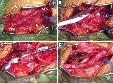 Multiple deep femoral artery aneurysms with Loeys-Dietz syndrome - Journal of Vascular Surgery ...