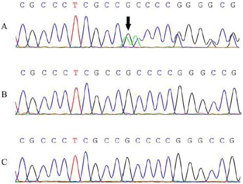 EA2 and temporal lobe epilepsy associated with a novel variant in CACNA1A - Seizure - European ...