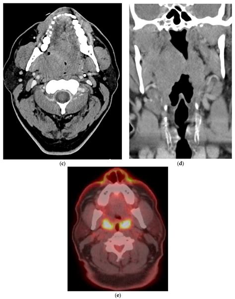Role of PET/CT in Oropharyngeal Cancers
