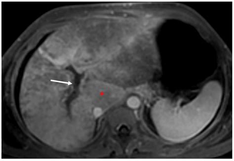 Budd-Chiari Syndrome Imaging Diagnosis: State of the Art and Future ...