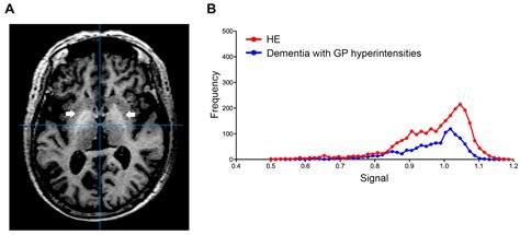 Development of a New Index to Distinguish Hepatic Encephalopathy ...