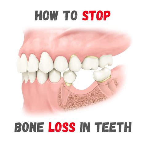 Stop Lost Tooth: How To Combat Bone Loss in Teeth