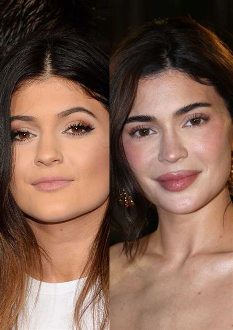 Celebs Before And After Lip Filler - Infoupdate.org