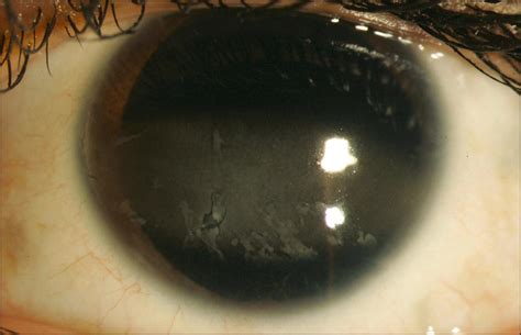 Juvenile Idiopathic Arthritis-Associated Uveitis - Clinical Tree